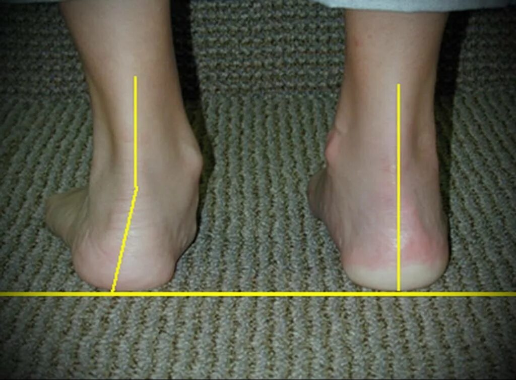 Операция на стопы обувь. Плоскостопный вальгусная стопа. Плоскостопии и вальгусной косточке. Плано-вальгусная деформация.
