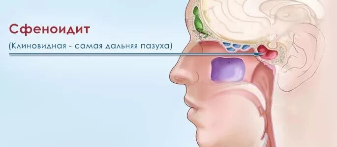 острый синусит сфеноидита. хронический гайморит этмоидит фронтит. воспаление придаточных пазух носа. гайморовы пазухи клиновидная. воспаление основной пазухи сфеноидит.
