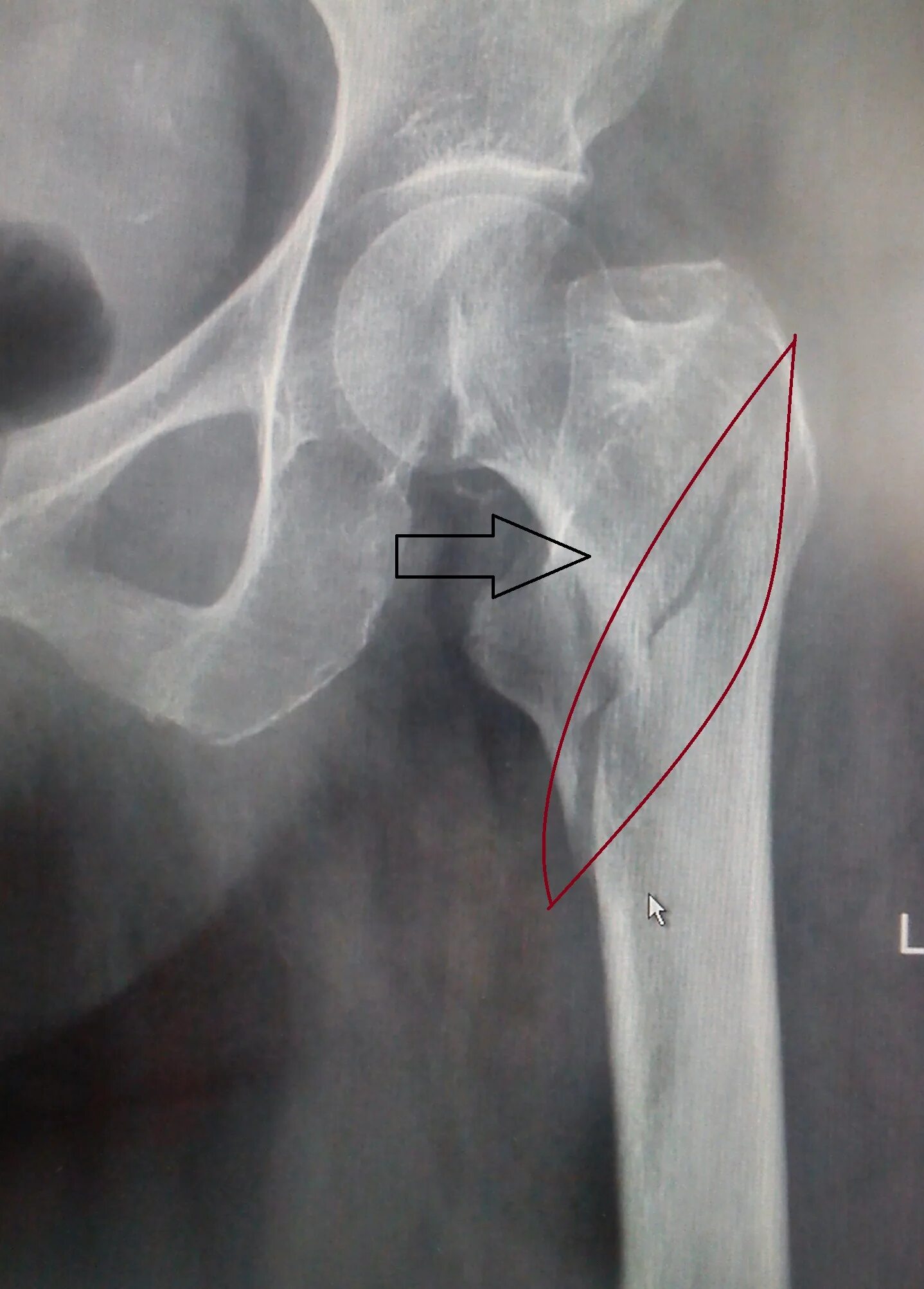 Трещина на верхних. Диафизарный перелом бедренной кости рентген. Винтообразный перелом бедра. Перелом диафиза бедра рентген. Подвертельный перелом бедра.