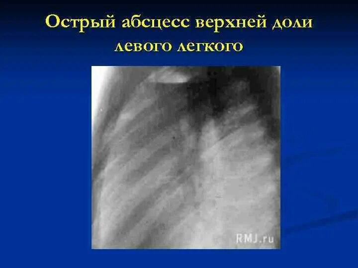 Абсцесс и гангрена легкого. Острый абсцесс легкого. Острый абсцесс легкого рентгенограмма. Абсцесс верхней доли лёгкого.