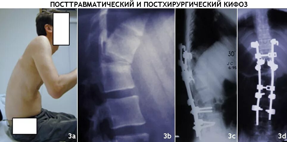 Болезнь шойерман мау что это такое. Шермана мау позвоночника. кифоз болезнь шейермана-мау. болезнь позвоночника шейермана-мау. операция кифоз грудного отдела.