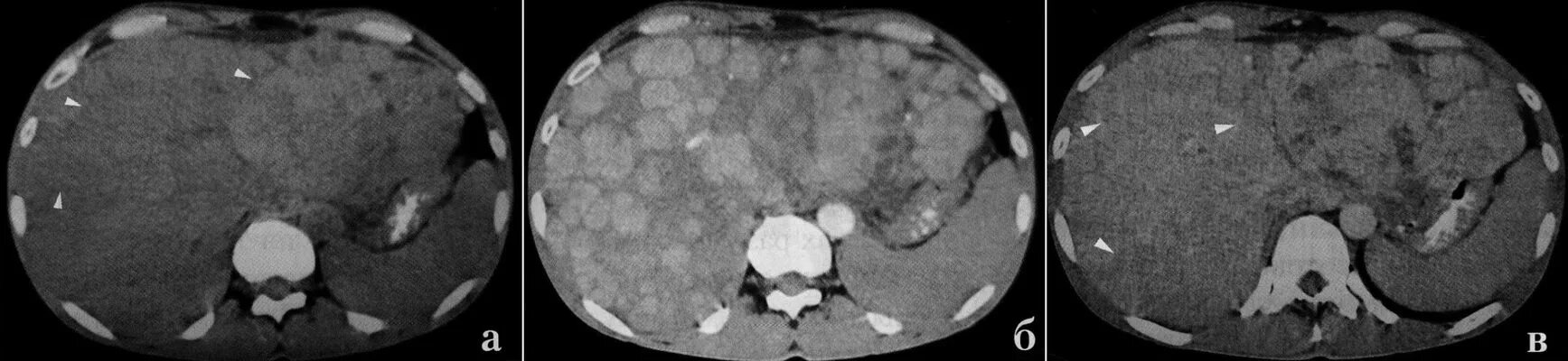 Метастазы в печень мкб. Крупноузловой цирроз печени кт. Мелкоузловой цирроз печени кт. Билиарный цирроз печени кт. Узловой цирроз печени на кт.