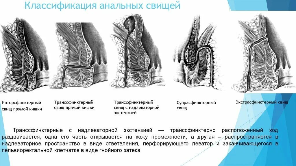 Транссфинктерный свищ прямой кишки. Транссфинктерные свищи прямой кишки. хронический парапроктит (свищи прямой кишки).. трансвинитный свищ прямой кишки. транссфинктерный парапроктит.