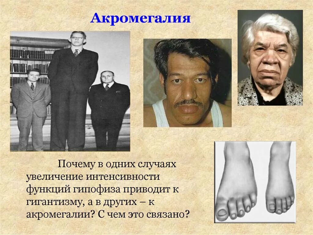 Акромегалия пропедевтика внутренних болезней. Клинические проявления акромегалии. Гигантизм у взрослого. Гигантизм эндокринное заболевание связанное с гипофункцией гипофиза. Соматотропный гормон акромегалия.
