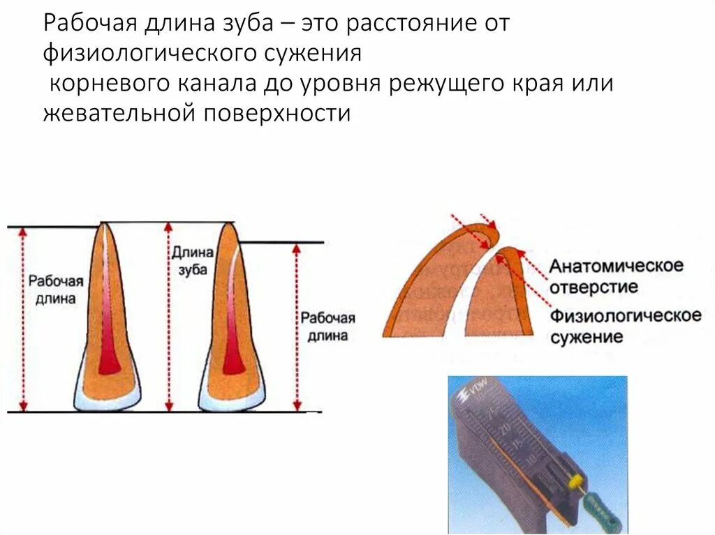 Определение корневых каналов. Рабочая длина зуба. Рабочая длина корневого канала. Определение рабочей длины зуба. Методы измерения рабочей длины корневого канала.