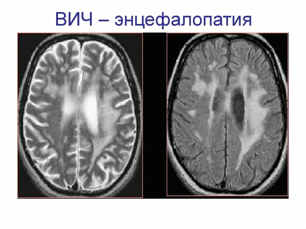 Резидуальные очаги головного мозга. ВИЧ ассоциированная энцефалопатия мрт. Герпетический энцефалит. Энцефалит головного мозга кт.