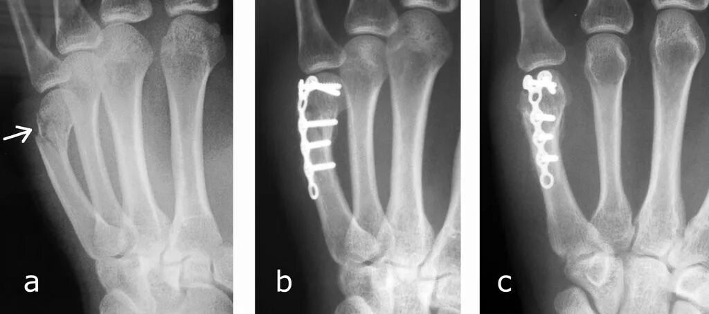 Трещина кости лечение. Перелом дистального метаэпифиза 5 пястной кости. Перелом 3 и 4 пястной кости. Закрытый субкапитальный перелом 1 пястной кости. Перелом 5 пястной кости рентген.
