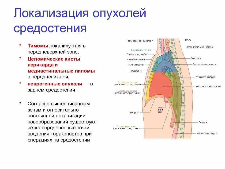 Размер средостения. Опухоли средостения классификация локализация. злокачественная опухоль средостения рентген схема. схема локализации новообразований в средостении. опухоли заднего средостения на кт.