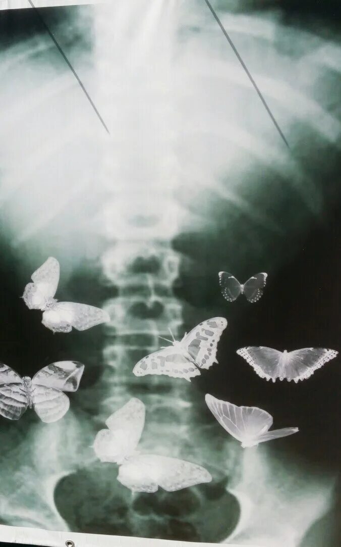 Выражение бабочки в животе