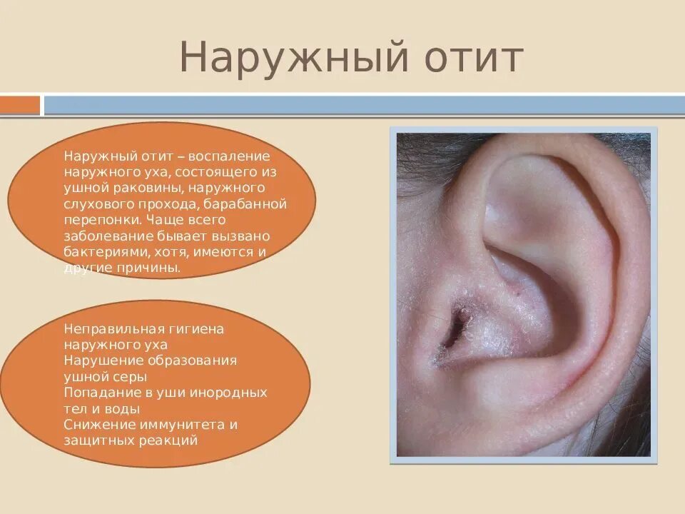 Что делать если у тебя болит ухо. Наружный отит отек слухового прохода. Острый наружный средний отит.