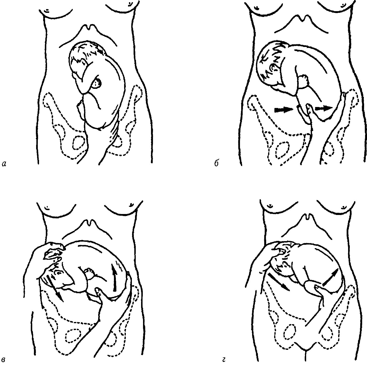 Как лежит малыш в животе. Леопольда Левицкого предлежание плода. Наружное акушерское исследование при тазовом предлежании. Приемы Леопольда при тазовом предлежании. Приемы Леопольда Левицкого.