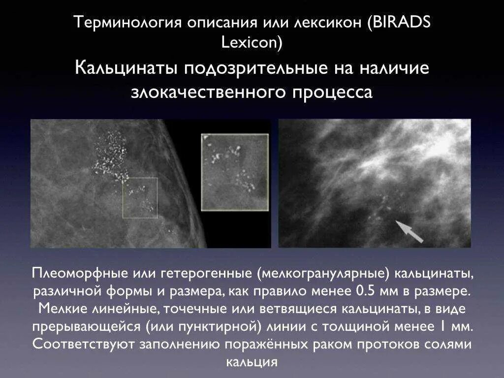 Справа bi rads 2. Маммография раковые микрокальцинаты. Протоковые кальцинаты. Аморфные микрокальцинаты в молочной железе. Множественные кальцинаты на маммографии.