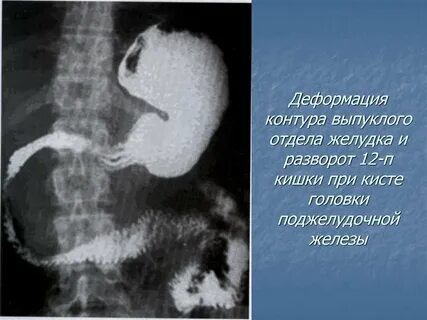 Деформация дпк