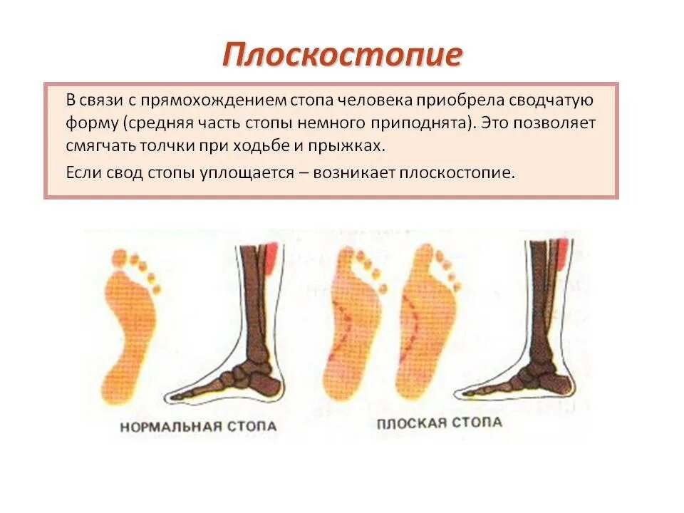 Чем может быть вызвано плоскостопие у человека. Плоскостопие вид сбоку. Строение стопы при плоскостопии. Стопа анатомия плоскостопие.