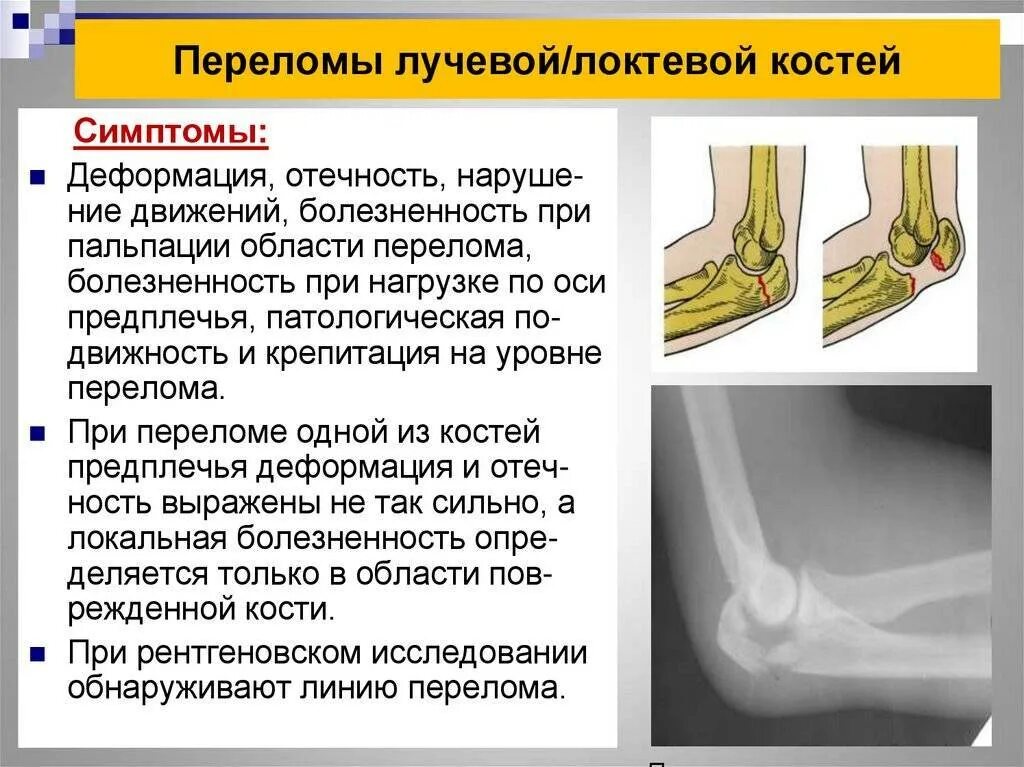 Перелом костей лучевой кости. Перелом локтевого отростка локтевого сустава. Гематома переломе локтевого отростка. Перелом проксимального отдела локтевой кости.