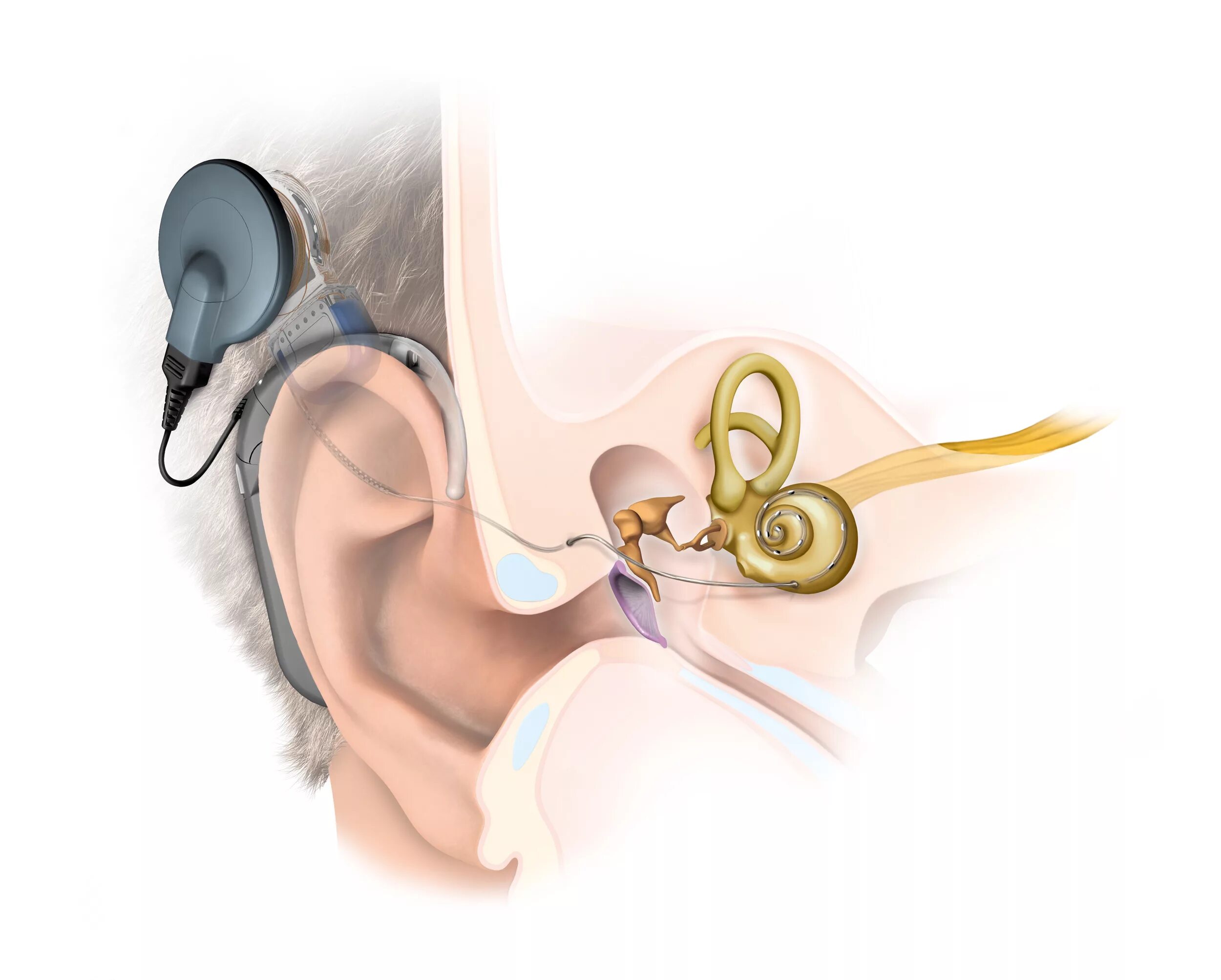 Аппарат для глухих кохлеарная имплантация. Кохлеарная имплантация Cochlear. Слуховой аппарат кохлеарный имплант операция. Операция на ухо на слух