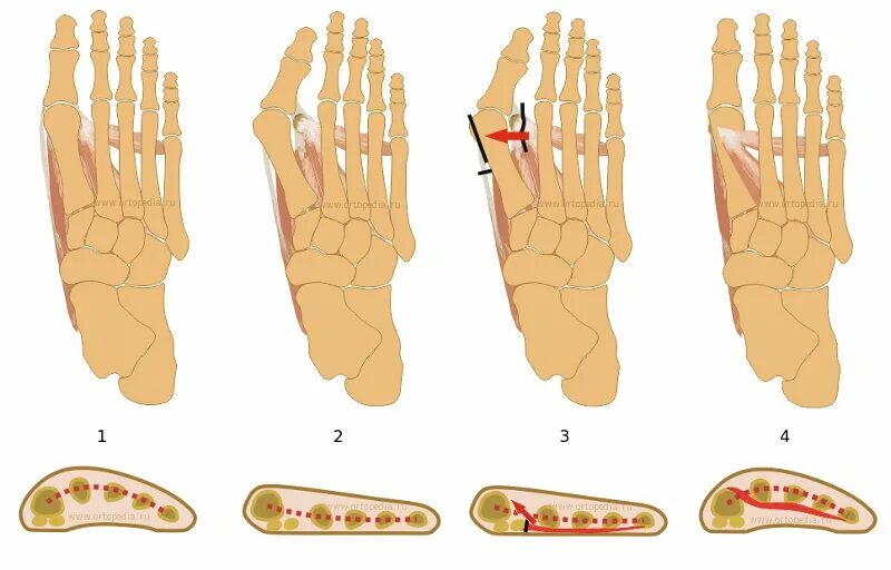 Поперечное плоскостопие вальгус. Вальгус поперечное плоскостопие операция. Поперечное плоскостопие плоская стопа. Вальгус деформация большого пальца стопы.
