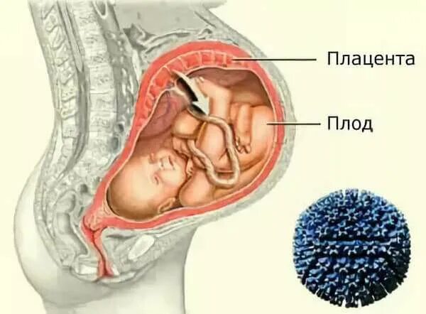 Передача от матери к плоду. Внутриутробное заражение ЦМВ. Внутриутробная инфекция цитомегалия. Внутриутробная инфекция у новорожденного цитомегаловирус. Цитомегаловирус трансплацентарный.
