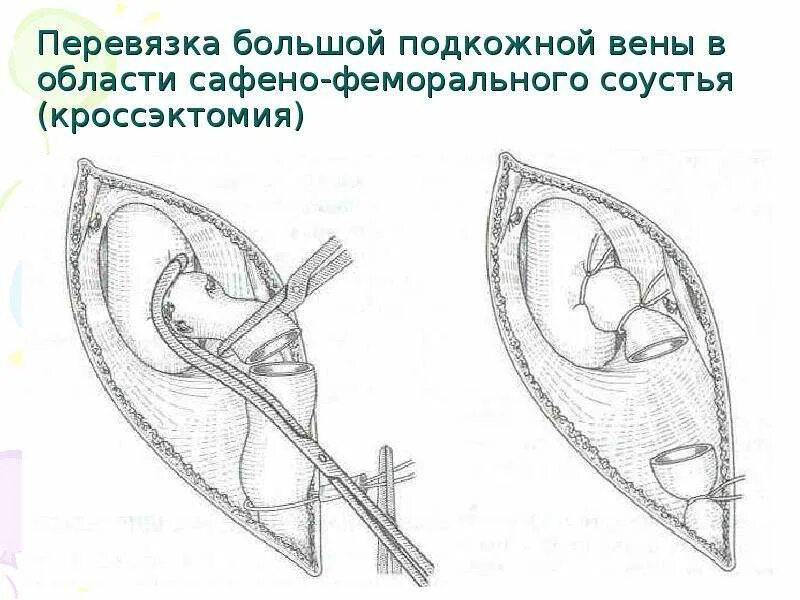 Кросэктомия. Операция троянова-тренделенбурга техника. Операция троянова-тренделенбурга. Кросэктомия. Кроссэктомия этапы операции.