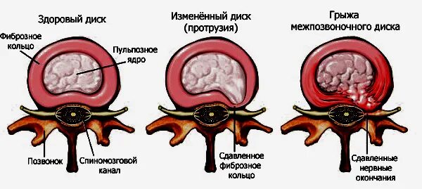 Дорзальная протрузия. Дорзальная протрузия межпозвонкового диска, грыжа дисков. Дорсальная протрузия межпозвонковых дисков. Дорзальная протрузия диска что это такое.