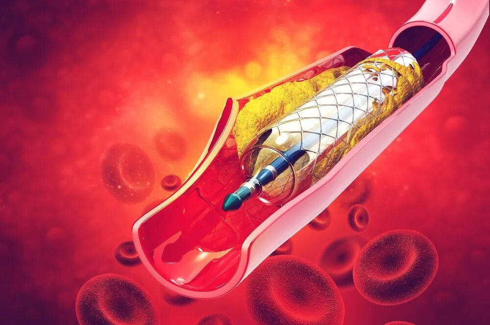 3 стента. Медицинский стент. Стенд медицинский сосуды.