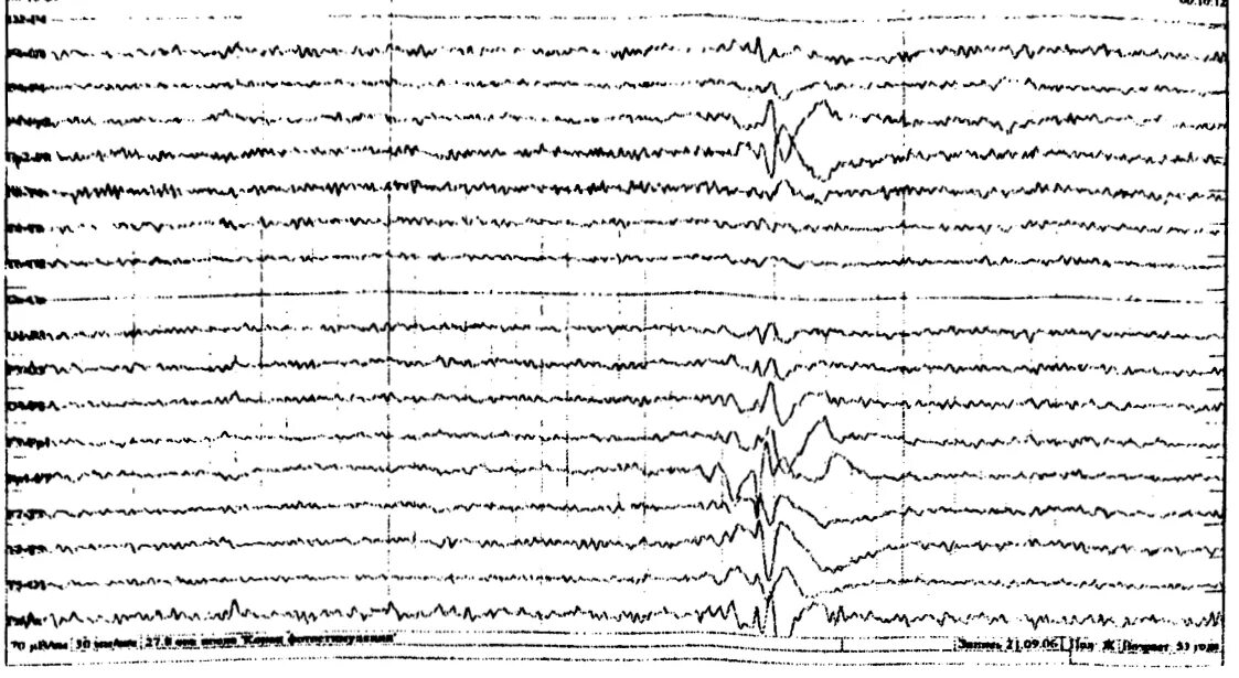 Лобная эпилепсия. Билатерально синхронные вспышки в ритма на ЭЭГ. Билатерально-синхронные вспышки что это. Эпилептиформная активность на ЭЭГ. Эпилептиформная активность на ЭЭГ фото.