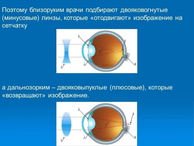 Линзы двояковыпуклые близорукость и дальнозоркость. Двояковогнутая линза. Двояковогнутая линза для близорукости. Двояковыпуклая линза для дальнозоркости.