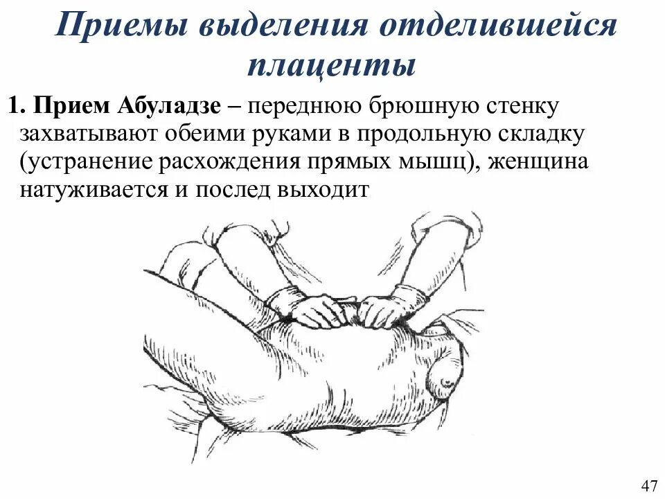 Выделение последа. Способы выделения последа (абуладзе, креде-лазаревича, гентера). наружные приемы выделения последа. методы выделения отделившегося последа. наружный метод выделения отделившегося последа.