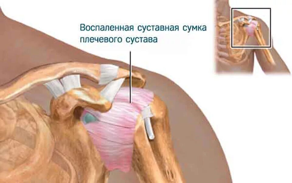 капсулит плечевого сустава. адгезивный капсулит плеча. капсулит плечевого сустава мрт. фиброзирующий капсулит. капсулит сустава.