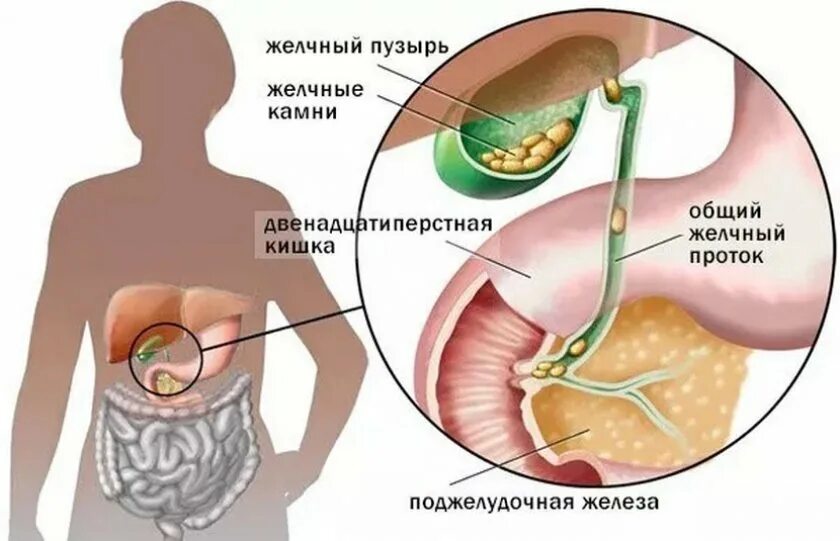 Почему болит желчный. Камни в желчном пузыре и поджелудочная железа. Камни в жёлчном пузыре симптомы. Камни в поджелудочном пузыре. Каменно желчная болезнь симптомы.