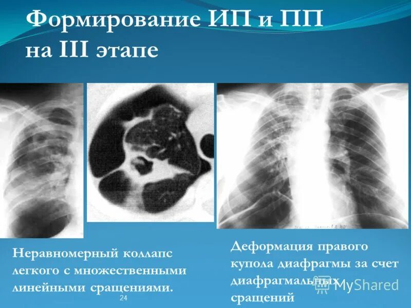 Плевральные спайки рентген. Релаксация диафрагмы ателектаз легкого. Плевроперикардиальная спайка рентген. Спайки куполов диафрагмы. Спайки куполов диафрагмы.