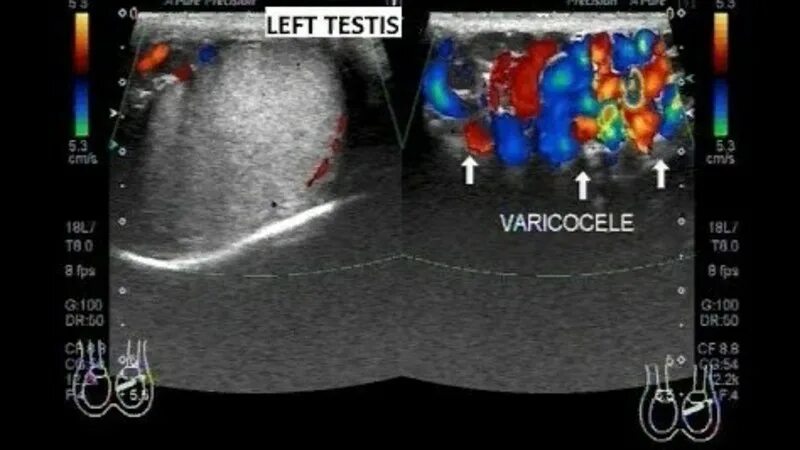 Спорт после варикоцеле. Субклиническое варикоцеле. Как делают операцию варикоцеле.