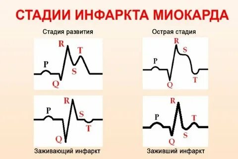 Острая фаза инфаркта