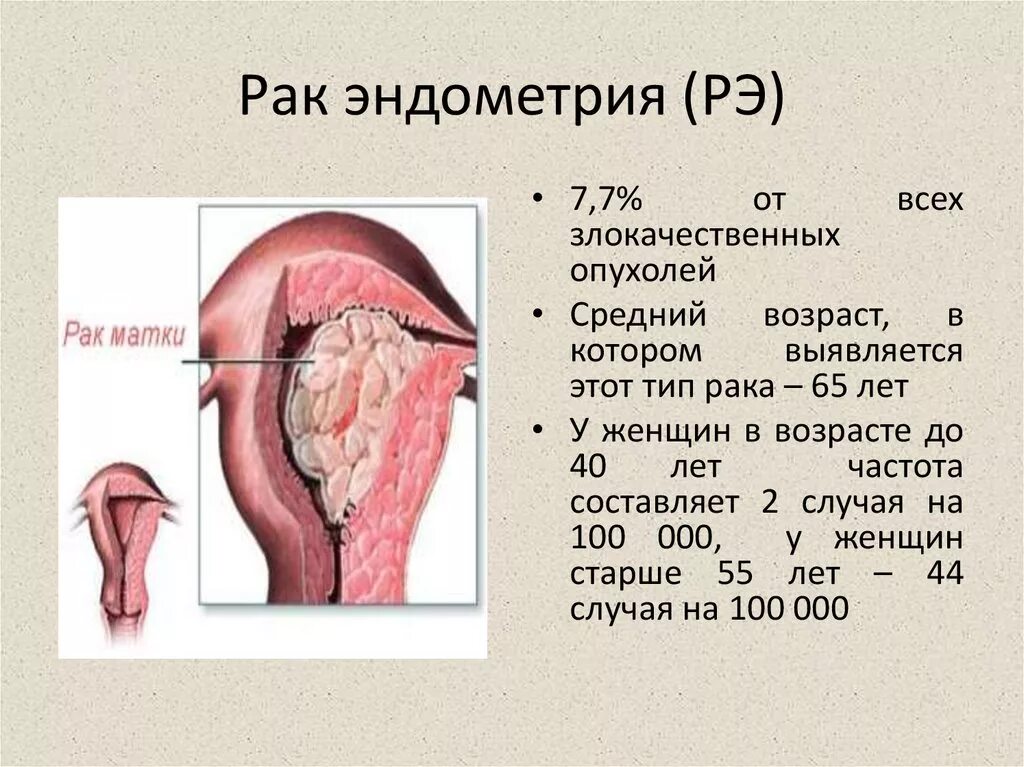 Кровотечение при раке матки. Карцинома эндометрия матки.