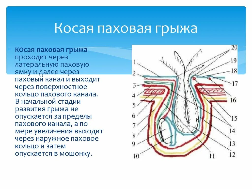 Косая и прямая паховая грыжа. Косая паховая грыжа грыжа. Прямая и косая паховые грыжи