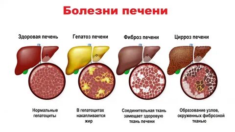 Фиброз печени 3 степени форум
