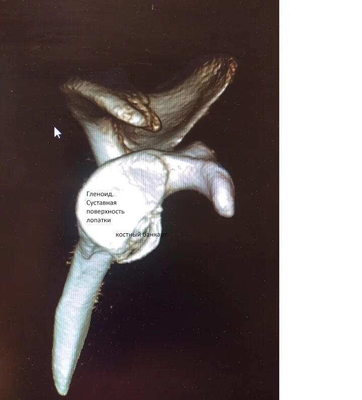 Костный Банкарт суставной впадины. Банкарт плечевой сустав. Костное повреждение Банкарта. Банкарт повреждение плечевого сустава.