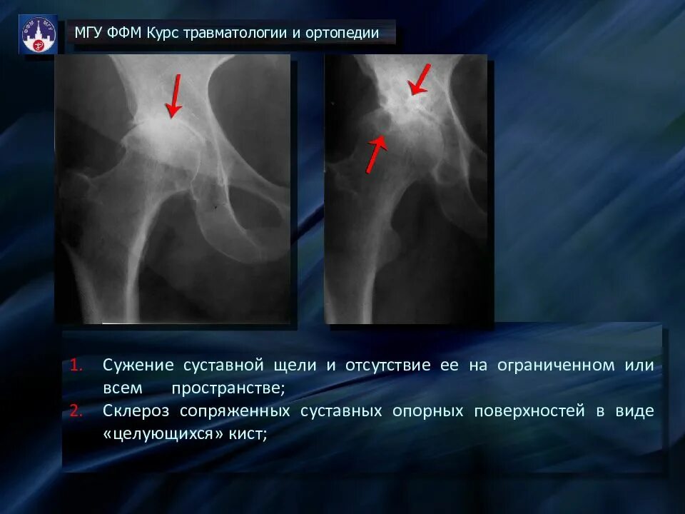 Склероз вертлужной впадины