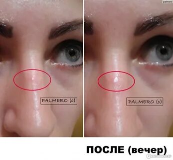 Ихтиол от прыщей