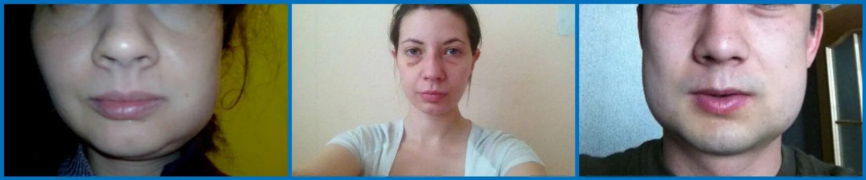 Опухает ли щека после удаления зуба. Опухла щека после зуба мудрости.