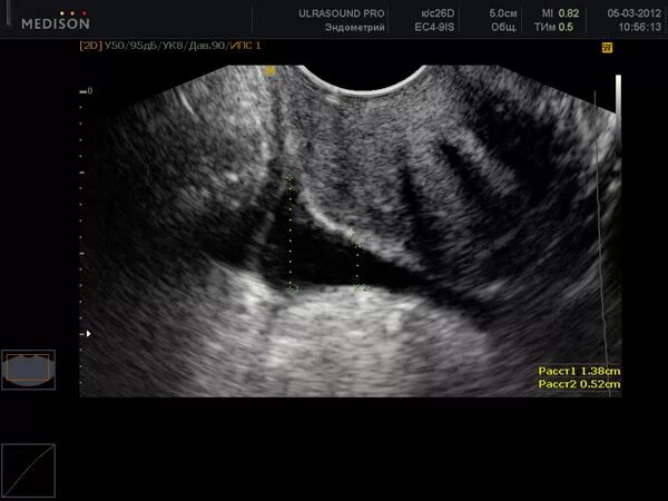 Гидросальпинкс на УЗИ. Маточные трубы на УЗИ фото. На узи видна труба