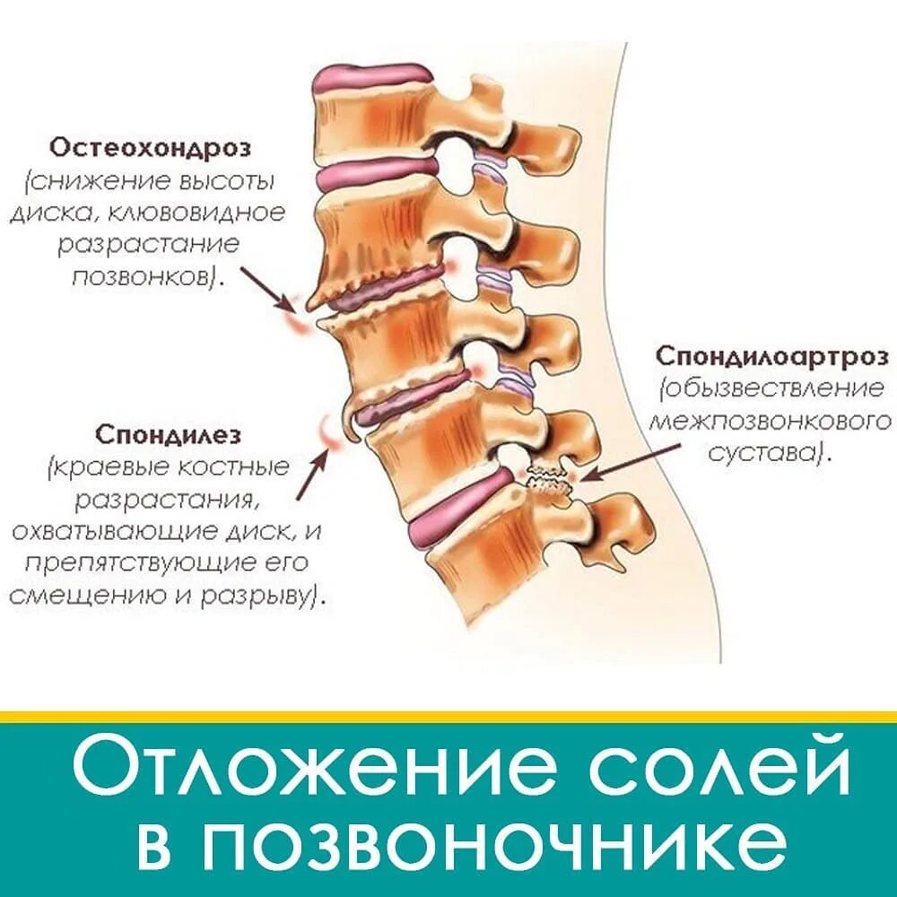 спондилез l5-s1. спондилолиз l5. спондилоартроз l2-3-4-5-s1. деформирующий спондилез спондилоартроз поясничного отдела. остеохондроз спондилоартроз l5-s1.