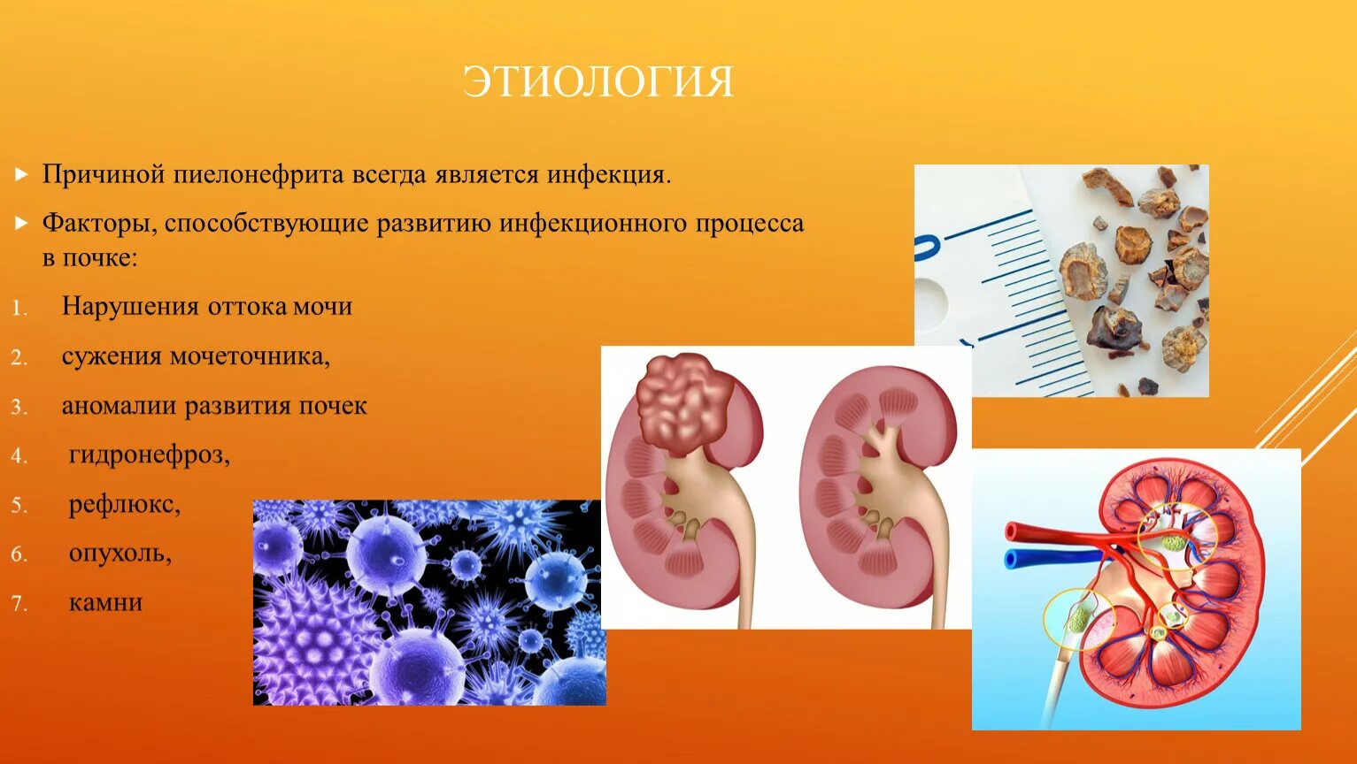 3 острый пиелонефрит. Пиелонефрит почки этиология. Мочекаменная болезнь хронический пиелонефрит. Хронический пиелонефрит этиопатогенез. Риски развития хронического пиелонефрита.