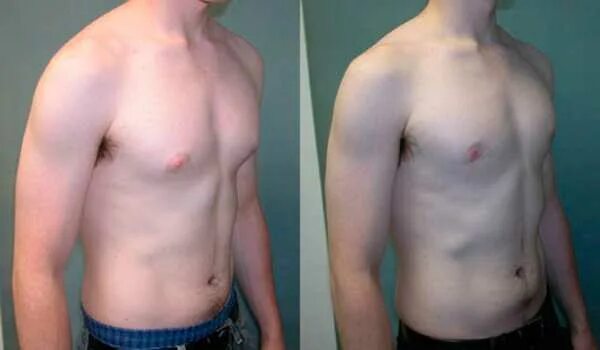 Гинекомастия пролиферирующая. Боль в груди у ребенка. Гинекомастия у подростков. Гинекомастия у подростков 12-15. Пубертатная гинекомастия.