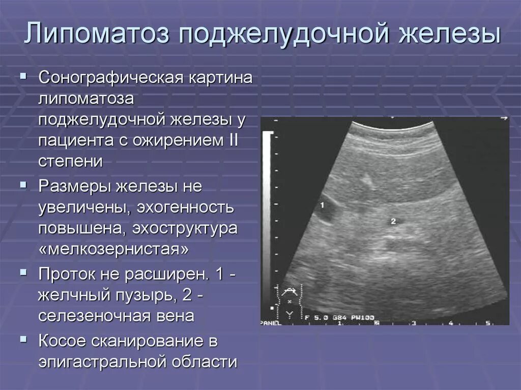 Что такое стеатоз поджелудочной железы. Липоматоза поджелудочной железы на УЗИ. Липоматоз поджелудочной железы. Лепатозподжелудочной железы. Липоматоза поджелудочной железы что это такое.