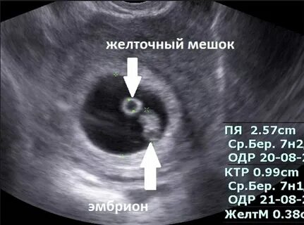 Яйцеклетка видна на узи