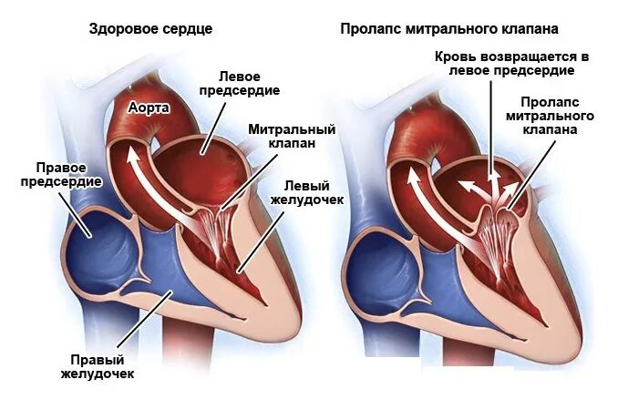 Недостаточность предсердия. Пролапс нейтрального клапана сердца 1 степени. Пролаз передней створки митрального клапана. Пролабирование створок митрального клапана 1. Диагноз:i34.1 пролапс пролабирование митрального клапана.