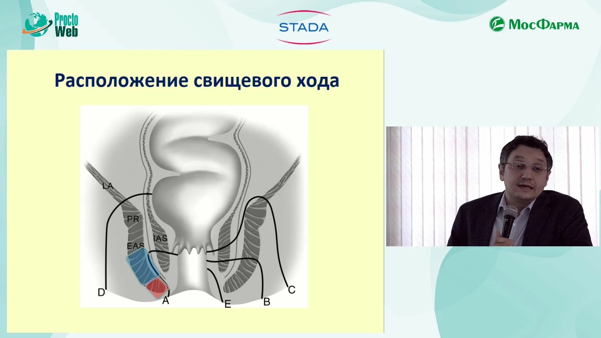 Лечение свища прямой кишки операция. Отверстие свища прямой кишки. транссфинктерный свищ. транссфинктерный свищ операция. неполный свищ прямой кишки.