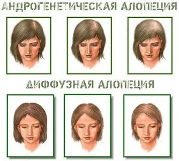 Мужской тип волос у женщин