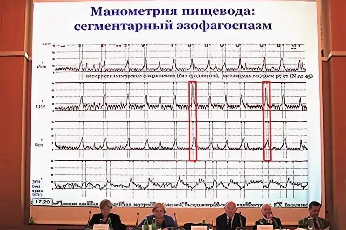 Антродуоденальная манометрия. Манометрия пищевода. Манометрия это. Эзофагеальная манометрия. Манометрия это.